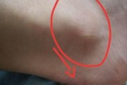 篮球运动中前后脚踝疼痛的原因及预防措施（保护脚踝，享受篮球运动乐趣）